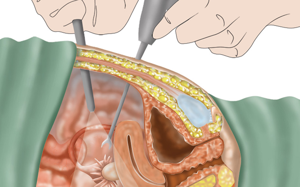 Endometriosis Treatment